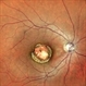 Macular Coloboma (RE)