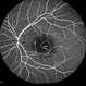 Central Areolar Choroidal Dystrophy Central Areolar Choroidal Dystrophy