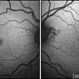 Macular Telangiectasia Type 2