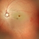 Central Retinal Artery Occlusion Central Retinal Artery Occlusion