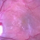 Epiretinal Membrane Epiretinal Membrane