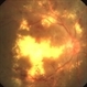 Proliferative diabetic retinopathy with dense macular hard exudates Proliferative diabetic retinopathy with dense macular hard exudates