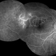Branch Retinal Vein Occlusion