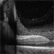 Blood in vitreous space