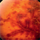 Acute Retinal Periphlebitis and Panuveitis OD Acute Retinal Periphlebitis and Panuveitis OD