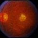 ARMD / Subfoveal CNVM ARMD / Subfoveal CNVM