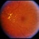 ARMD / Subfoveal CNVM ARMD / Subfoveal CNVM