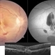 Choroidal Tear-Multimodal imaging Choroidal Tear-Multimodal imaging