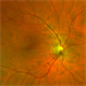 Scanning Image of Choroidal Folds Scanning Image of Choroidal Folds