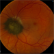 Melanocytoma