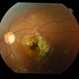 Macular Coloboma