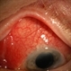 Scleritis Scleritis