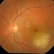 Tuberculoma