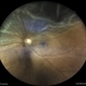 Superior Retinal Detachment Superior Retinal Detachment