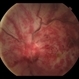 Ophthalmic Artery Occlusion