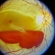 Subhyaloid Haemorrhage
