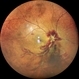 Occlusive Vasculitis Occlusive Vasculitis