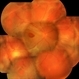Retinal Detachment With PVR and Macular Hole