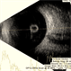 Vitreous Cyst With Vitreous Hemorrhage in a Case of Retinitis Pigmentosa Vitreous Cyst With Vitreous Hemorrhage in a Case of Retinitis Pigmentosa