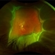 Disseminated Retinitis and Retinochoroiditis, Metastatic