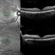 Purtscher's Retinopathy Purtscher's Retinopathy