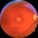 Adult-onset foveomacular vitelliform dystrophy Adult-onset foveomacular vitelliform dystrophy