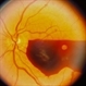 Subhyaloid Haemorrhage