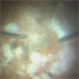 Vitreoschisis Membrane in Myopic Traction Maculopathy Vitreoschisis Membrane in Myopic Traction Maculopathy
