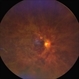 Combined central retinal vein and artery occlusion Combined central retinal vein and artery occlusion