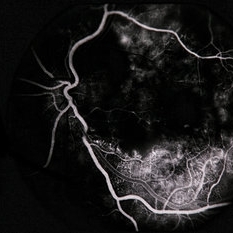 Heme Exudate Ischemia From Multiple Myeloma - Retina Image Bank