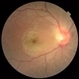 Neuroretinitis Neuroretinitis