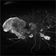 Severe Diabetic Retinopathy,  Nonperfusion and NVE Severe Diabetic Retinopathy,  Nonperfusion and NVE