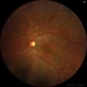 Chronic Central Serous Chrorioretinopathy Chronic Central Serous Chrorioretinopathy