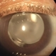 PCIOL Opacification PCIOL Opacification