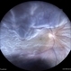 Rhegmatogenous Retina Detachment