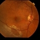 Retinoschisis with Outer Layer Break Retinoschisis with Outer Layer Break