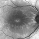 Central Retinal Artery Occlusion Autoflourescence Central Retinal Artery Occlusion Autoflourescence