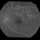 BRVO With Non-perfusion