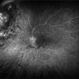Radiation Retinopathy; BRVO with Macular Edema Radiation Retinopathy; BRVO with Macular Edema