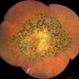 Tapetoretinal Degeneration