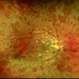 APLA syndrome with Systemic lupus erythematosus retinopathy APLA syndrome with Systemic lupus erythematosus retinopathy