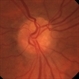 Optic Nerve Head Drusen - Fundus Image