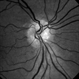 Optic Nerve Head Drusen - Red Free