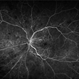 Central Retinal Vein Occlusion With Waldenstroms macroglobulinemia Central Retinal Vein Occlusion With Waldenstroms macroglobulinemia