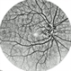 Congenital Peripapillary Vascular Loops Congenital Peripapillary Vascular Loops
