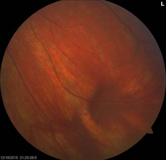 Varices OS Prominent Vortex Vein Ampulla - Retina Image Bank