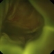 Choroidal Detachment Choroidal Detachment