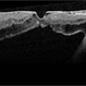 Myopic Traction Maculopathy Myopic Traction Maculopathy
