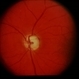 Sturge-Weber / Choroidal Hemangioma Sturge-Weber / Choroidal Hemangioma
