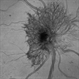 Neovascularization of the Disc Neovascularization of the Disc